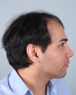 Before Hair Transplant&nbsp;Front